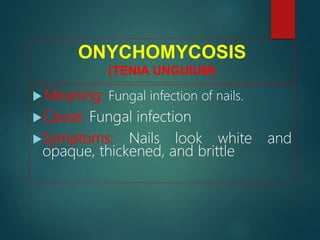 ONYCHOMYCOSIS
(TENIA UNGUIUM)
 Meaning: Fungal infection of nails.
Cause: Fungal infection
Symptoms: Nails look white and
opaque, thickened, and brittle
 