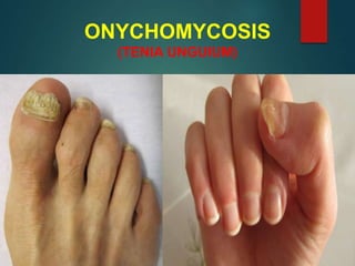 ONYCHOMYCOSIS
(TENIA UNGUIUM)
 