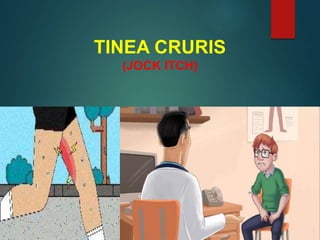 TINEA CRURIS
(JOCK ITCH)
 