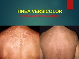 TINEA VERSICOLOR
(PITYRIASIS VERSICOLOR)
 