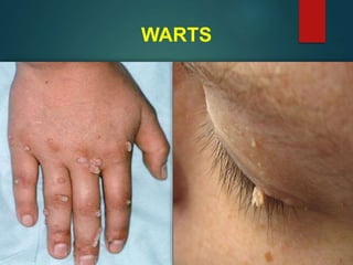 WARTS
 