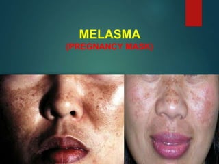 MELASMA
(PREGNANCY MASK)
 