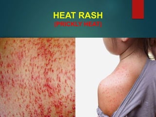 HEAT RASH
(PRICKLY HEAT)
 