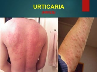 URTICARIA
(HIVES)
 
