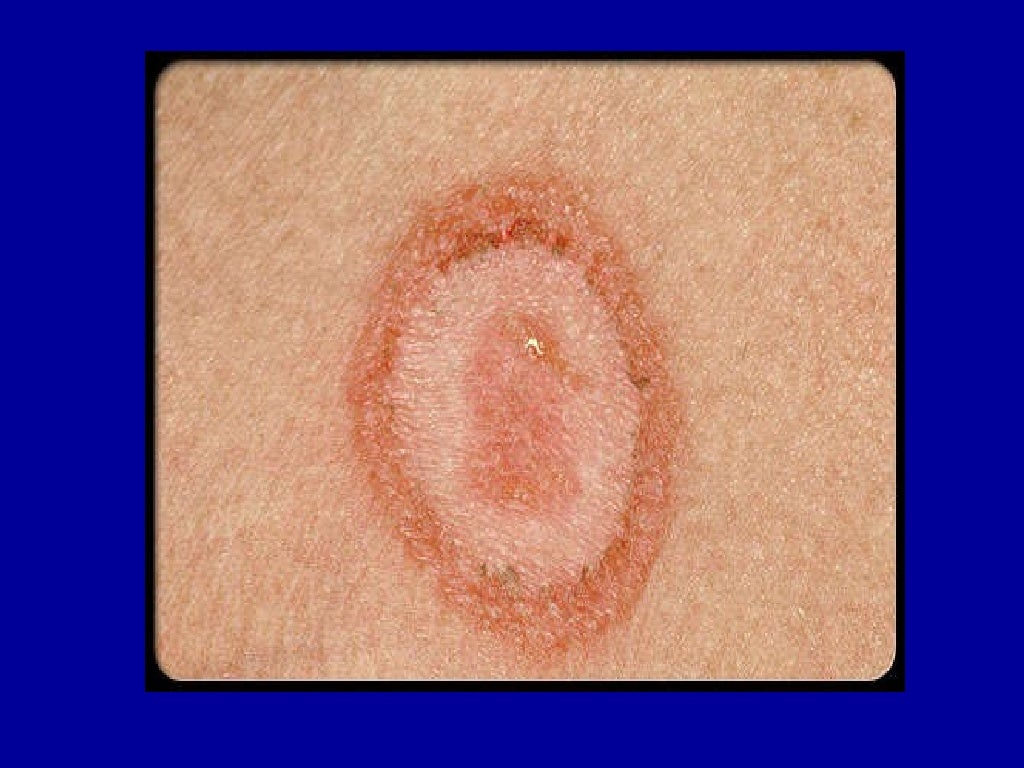 Haole Rot Holy Skin Disease _ Holly Diseases & Insect Pests – AQAL