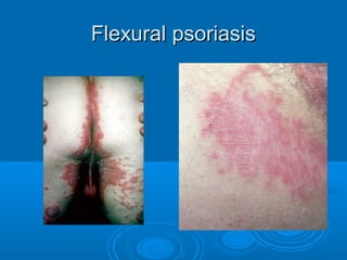 FFlleexxuurraall ppssoorriiaassiiss 
 