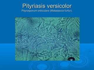 PPiittyyrriiaassiiss vveerrssiiccoolloorr 
PPiittyyrroossppoorruumm oorrbbiiccuullaarree ((MMaallaasssseezziiaa ffuurrffuurr)).. 
 