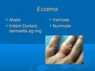 EEcczzeemmaa 
 AAttooppiicc 
 IIrrrriittaanntt CCoonnttaacctt 
ddeerrmmaattiittiiss eegg rriinngg 
 VVaarriiccoossee 
 NNuummnnuullaarr 
 