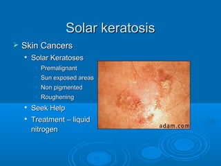 SSoollaarr kkeerraattoossiiss 
 SSkkiinn CCaanncceerrss 
 SSoollaarr KKeerraattoosseess 
• PPrreemmaalliiggnnaanntt 
• SSuunn eexxppoosseedd aarreeaass 
• NNoonn ppiiggmmeenntteedd 
• RRoouugghheenniinngg 
 SSeeeekk HHeellpp 
 TTrreeaattmmeenntt –– lliiqquuiidd 
nniittrrooggeenn 
 