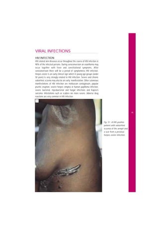 Seroconversion Skin Rash Common Skin Diseases in Africa Illustrated Guide 2001.pdf