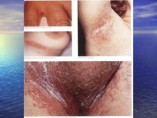Common skin infections | PPT