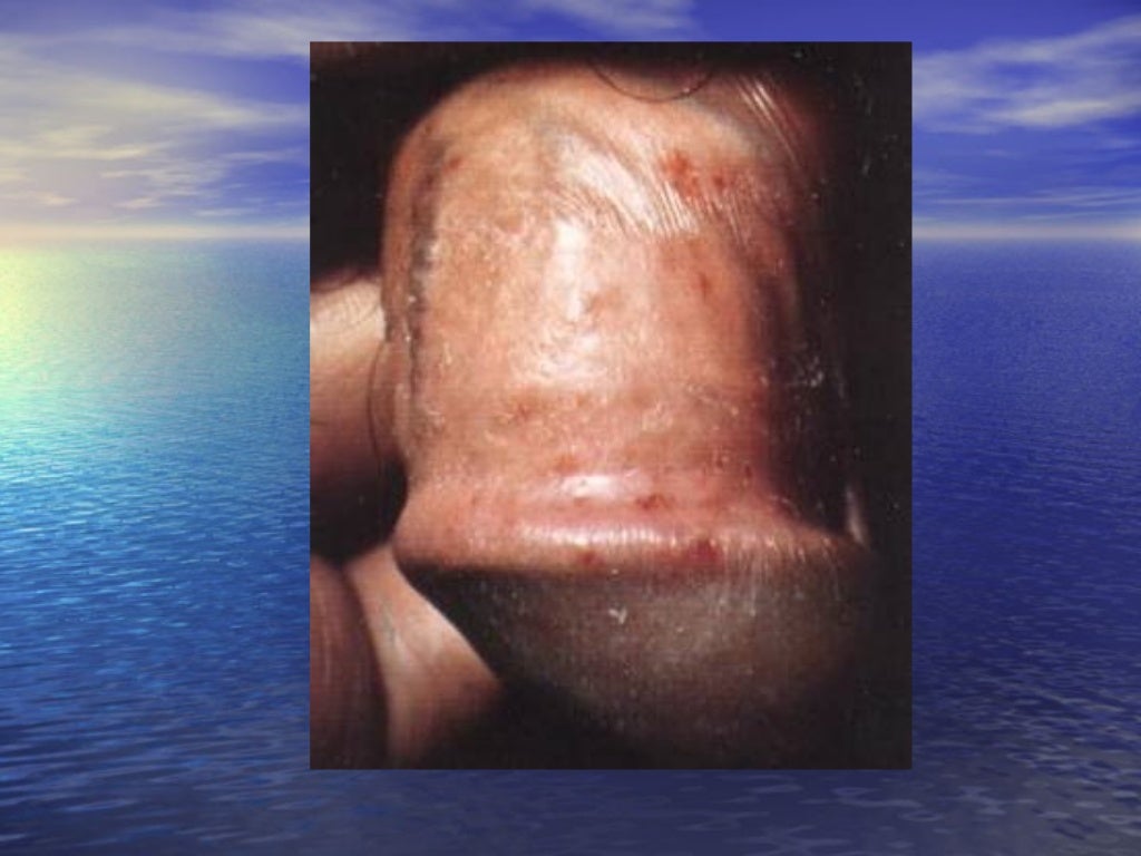 Common skin infections