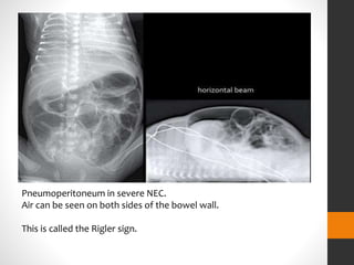 Common surgical abdomen scenarios and management dr.mounika | PPTX