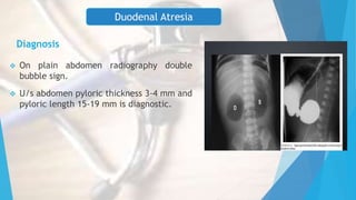 Diagnosis
 On plain abdomen radiography double
bubble sign.
 U/s abdomen pyloric thickness 3-4 mm and
pyloric length 15-19 mm is diagnostic.
Duodenal Atresia
 