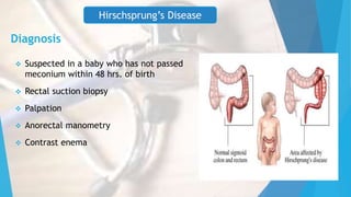 Diagnosis
 Suspected in a baby who has not passed
meconium within 48 hrs. of birth
 Rectal suction biopsy
 Palpation
 Anorectal manometry
 Contrast enema
Hirschsprung’s Disease
 
