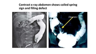 common surgical problem in pediatrics done.pptx