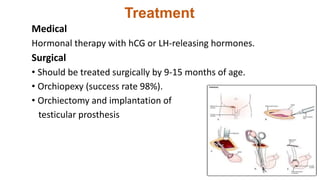Treatment
Medical
Hormonal therapy with hCG or LH-releasing hormones.
Surgical
• Should be treated surgically by 9-15 months of age.
• Orchiopexy (success rate 98%).
• Orchiectomy and implantation of
testicular prosthesis
 