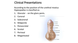 Clinical Presentations
According to the position of the urethral meatus
Hypospadias is classified as-
1. Glanular - on the glans penis.
2. Coronal
3. Subcoronal
4. Midpenile
5. Penoscrotal
6. Scrotal
7. Perineal
8. Megameatal
 