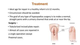 Treatment
• Ideal age for repair in a healthy infant is 6-12 months.
• Circumcision should be avoided.
• The goal of any type of hypospadias surgery is to make a normal,
straight penis with a urinary channel that ends at or near the tip.
Surgery –
• Tubularized incised plate repair.
• Almost all cases are repaired in
a single operation except
Proximal cases.
 