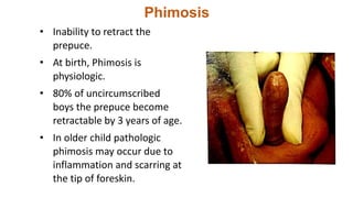 Phimosis
• Inability to retract the
prepuce.
• At birth, Phimosis is
physiologic.
• 80% of uncircumscribed
boys the prepuce become
retractable by 3 years of age.
• In older child pathologic
phimosis may occur due to
inflammation and scarring at
the tip of foreskin.
 