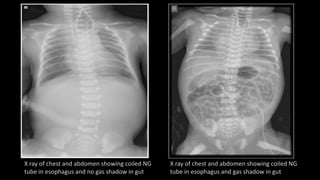 X ray of chest and abdomen showing coiled NG
tube in esophagus and no gas shadow in gut
X ray of chest and abdomen showing coiled NG
tube in esophagus and gas shadow in gut
 