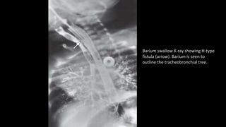 Barium swallow X-ray showing H-type
fistula (arrow). Barium is seen to
outline the tracheobronchial tree.
 