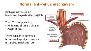 Reflux is prevented by
lower esophageal sphincter(LES)
The LES is supported by
• Right crus of the diaphragm
• Angle of his.
There is balance between
intra-esophageal pressure and
intra-abdominal pressure
Normal anti-reflux mechanism
 
