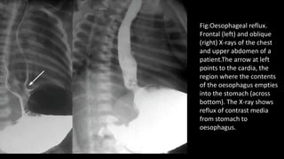 Fig:Oesophageal reflux.
Frontal (left) and oblique
(right) X-rays of the chest
and upper abdomen of a
patient.The arrow at left
points to the cardia, the
region where the contents
of the oesophagus empties
into the stomach (across
bottom). The X-ray shows
reflux of contrast media
from stomach to
oesophagus.
 