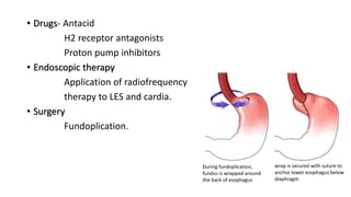 • Drugs- Antacid
H2 receptor antagonists
Proton pump inhibitors
• Endoscopic therapy
Application of radiofrequency
therapy to LES and cardia.
• Surgery
Fundoplication.
During fundoplication,
fundus is wrapped around
the back of esophagus
wrap is secured with suture to
anchor lower esophagus below
diaphragm
 