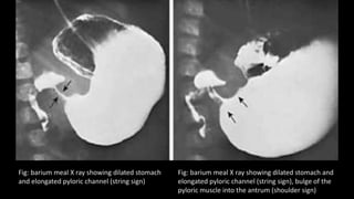 Fig: barium meal X ray showing dilated stomach
and elongated pyloric channel (string sign)
Fig: barium meal X ray showing dilated stomach and
elongated pyloric channel (string sign), bulge of the
pyloric muscle into the antrum (shoulder sign)
 