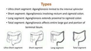Types
• Ultra short segment: Aganglionosis limited to the internal sphincter
• Short segment: Aganglionosis involving rectum and sigmoid colon.
• Long segment: Aganglionosis extends proximal to sigmoid colon
• Total segment: Aganglionosis affects entire large gut and portion of
terminal ileum.
Short segment Long segment Total segmentUltra-Short segment
 