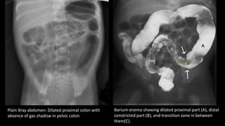 Plain Xray abdomen: Dilated proximal colon with
absence of gas shadow in pelvic colon
Barium enema showing dilated proximal part (A), distal
constricted part (B), and transition zone in between
them(C).
 