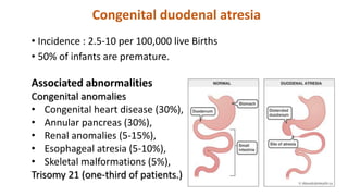 Congenital duodenal atresia
• Incidence : 2.5-10 per 100,000 live Births
• 50% of infants are premature.
Associated abnormalities
Congenital anomalies
• Congenital heart disease (30%),
• Annular pancreas (30%),
• Renal anomalies (5-15%),
• Esophageal atresia (5-10%),
• Skeletal malformations (5%),
Trisomy 21 (one-third of patients.)
 