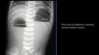 Plain Xray of abdomen: showing
double bubble shadow
Stomach
Duodenum
 