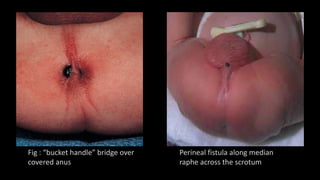 Perineal fistula along median
raphe across the scrotum
Fig : “bucket handle” bridge over
covered anus
 
