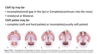 Cleft lip may be-
• Incomplete(small gap in the lip) or Complete(continues into the nose).
• Unilateral or Bilateral.
Cleft palate may be-
• complete (soft and hard palate) or Incomplete(usually soft palate)
 
