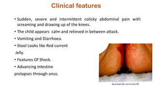 Clinical features
• Sudden, severe and intermittent colicky abdominal pain with
screaming and drawing up of the knees.
• The child appears calm and relieved in between attack.
• Vomiting and Diarrhoea.
• Stool Looks like Red current
Jelly.
• Features Of Shock.
• Advancing intestine
prolapses through anus.
 
