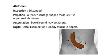 Abdomen
Inspection : Distended
Palpation : A tender sausage shaped mass is felt in
upper mid abdomen.
Auscultation : bowel sound may be absent.
Digital Rectal Examination : Bloody mucus in fingers.
 