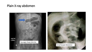 Plain X-ray abdomen
Small bowel dilatation
Sausage shape density
 