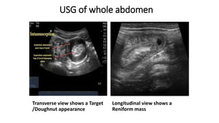 USG of whole abdomen
Transverse view shows a Target
/Doughnut appearance
Longitudinal view shows a
Reniform mass
 