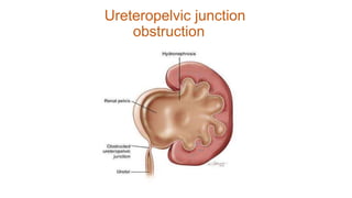 Ureteropelvic junction
obstruction
 