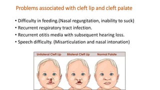Problems associated with cleft lip and cleft palate
• Difficulty in feeding.(Nasal regurgitation, inability to suck)
• Recurrent respiratory tract infection.
• Recurrent otitis media with subsequent hearing loss.
• Speech difficulty. (Misarticulation and nasal intonation)
 