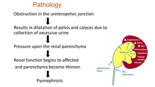 Pathology
Obstruction in the ureteropelvic junction
Results in dilatation of pelvis and calyces due to
collection of excessive urine
Pressure upon the renal parenchyma
Renal function begins to affected
and parenchyma become thinner.
Pyonephrosis
 