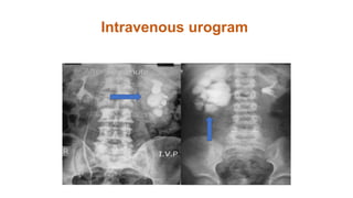 Intravenous urogram
 