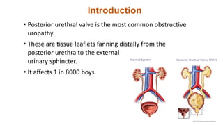 Introduction
• Posterior urethral valve is the most common obstructive
uropathy.
• These are tissue leaflets fanning distally from the
posterior urethra to the external
urinary sphincter.
• It affects 1 in 8000 boys.
 