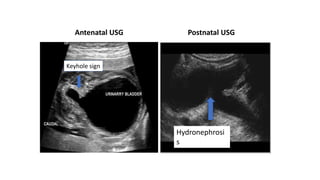 Antenatal USG Postnatal USG
Keyhole sign
Hydronephrosi
s
 