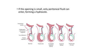 • If the opening is small, only peritoneal fluid can
enter, forming a hydrocele.
 