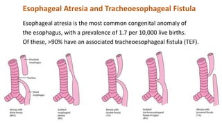 Esophageal Atresia and Tracheoesophageal Fistula
Esophageal atresia is the most common congenital anomaly of
the esophagus, with a prevalence of 1.7 per 10,000 live births.
Of these, >90% have an associated tracheoesophageal fistula (TEF).
 