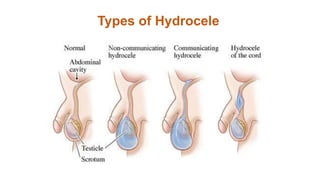 Types of Hydrocele
 