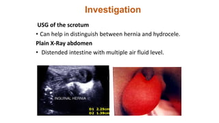 Investigation
USG of the scrotum
• Can help in distinguish between hernia and hydrocele.
Plain X-Ray abdomen
• Distended intestine with multiple air fluid level.
 